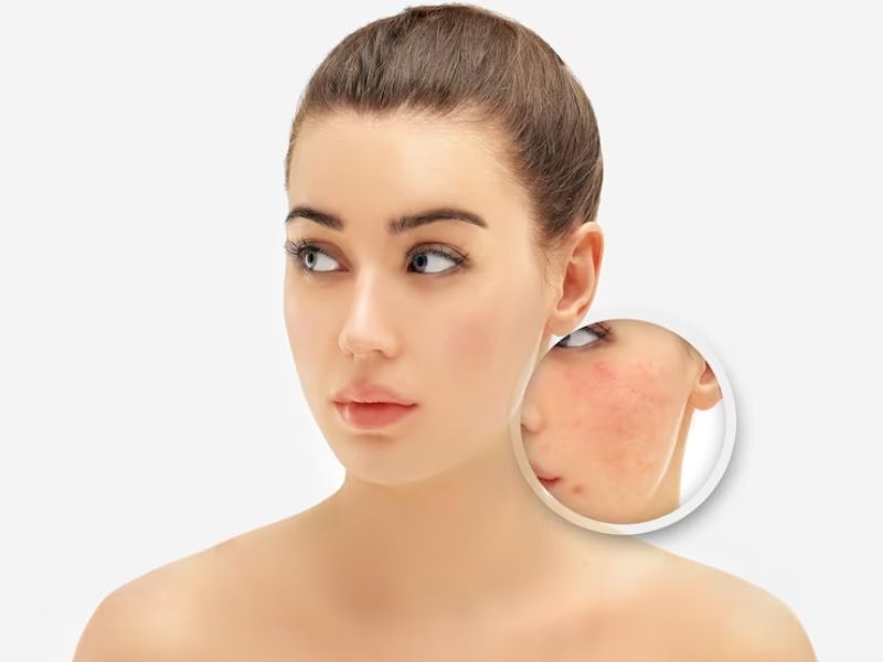 What Should You Know About Blackhead Removal for Oily Skin? Skincare Tips